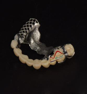 สะพาน Contour Zirconia และกรอบโลหะ