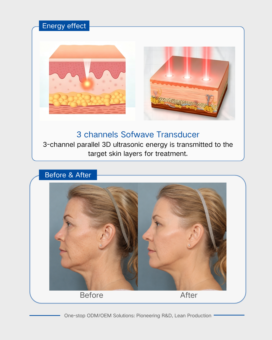 3 channels Sofwave Transducer