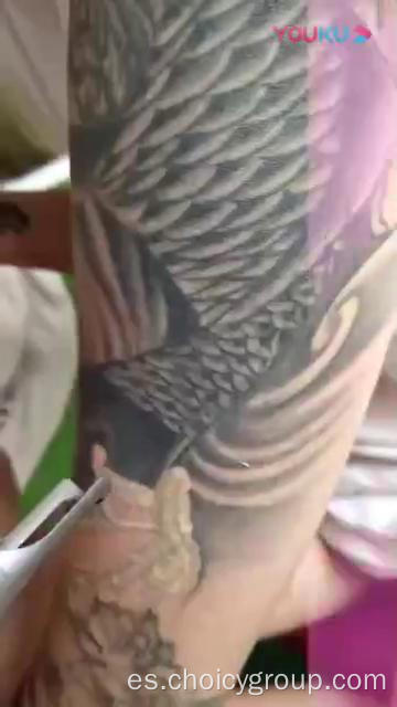 Choicy Q Switched ND: Desmontaje del tatuaje con láser YAG