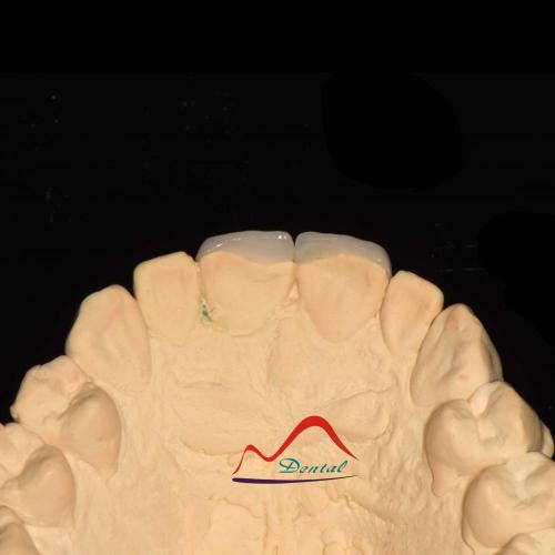 Dental Aesthetic Porcelain Veneers