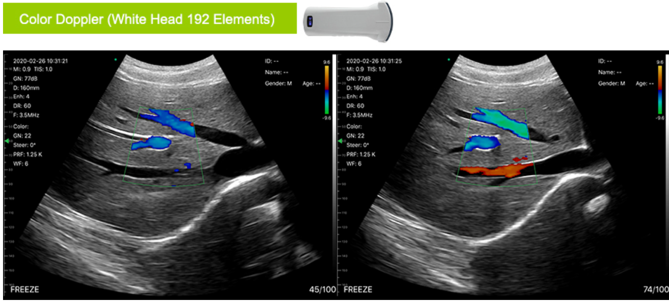 Wireless Handheld Ultrasound Probe Doppler