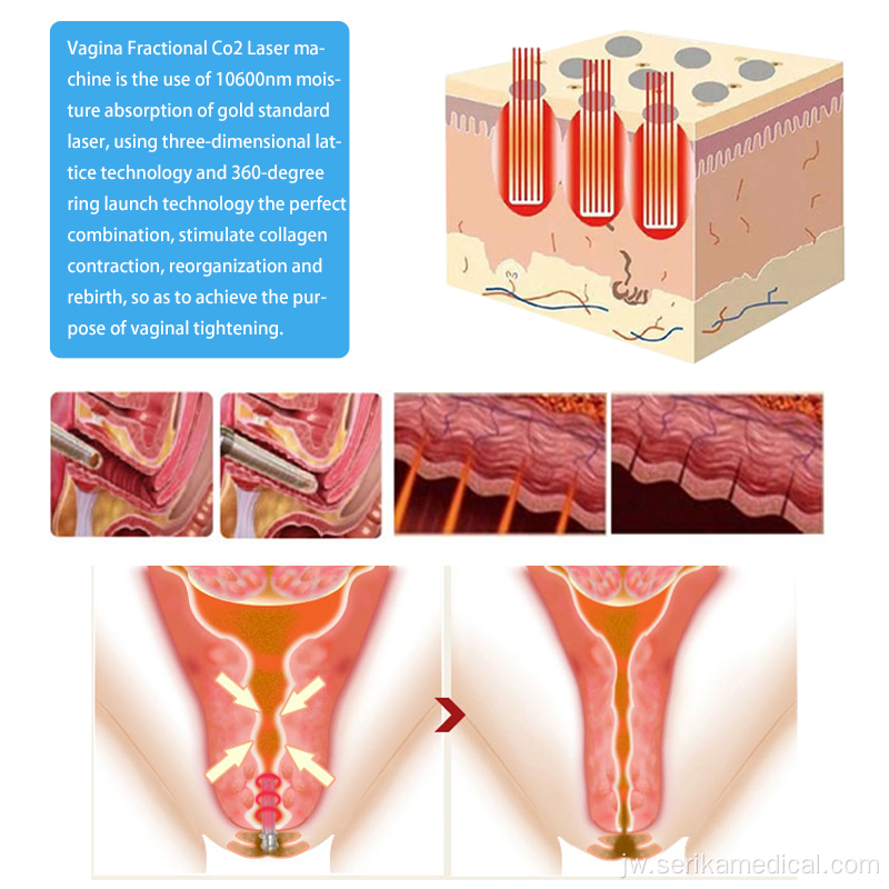 Laser laser laser fractional acne