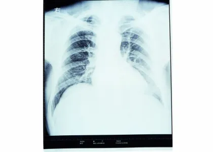 Medical Imaging Films X-ray Dry Film Knd-a For Agfa 5300, 5302, 5500, 5502, 3000