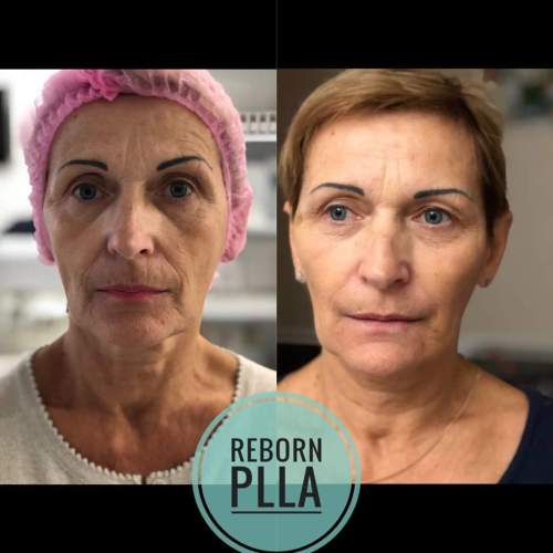 Reborn Plumping Up Face Hand Body Dermal Filler