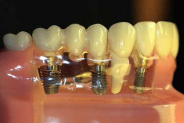 implant tooth