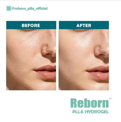 Mesotherapy Products Injection PLLA Hydrogel Filler