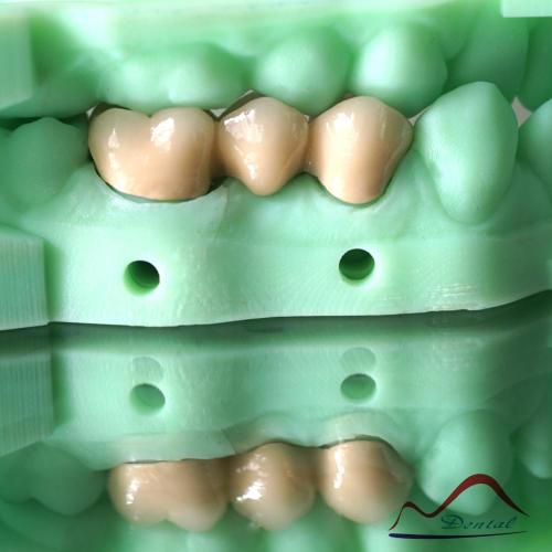 3D Printing Model PFM COCR Bridge