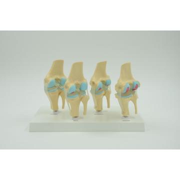 MODEL LESSION KNEE JOINT