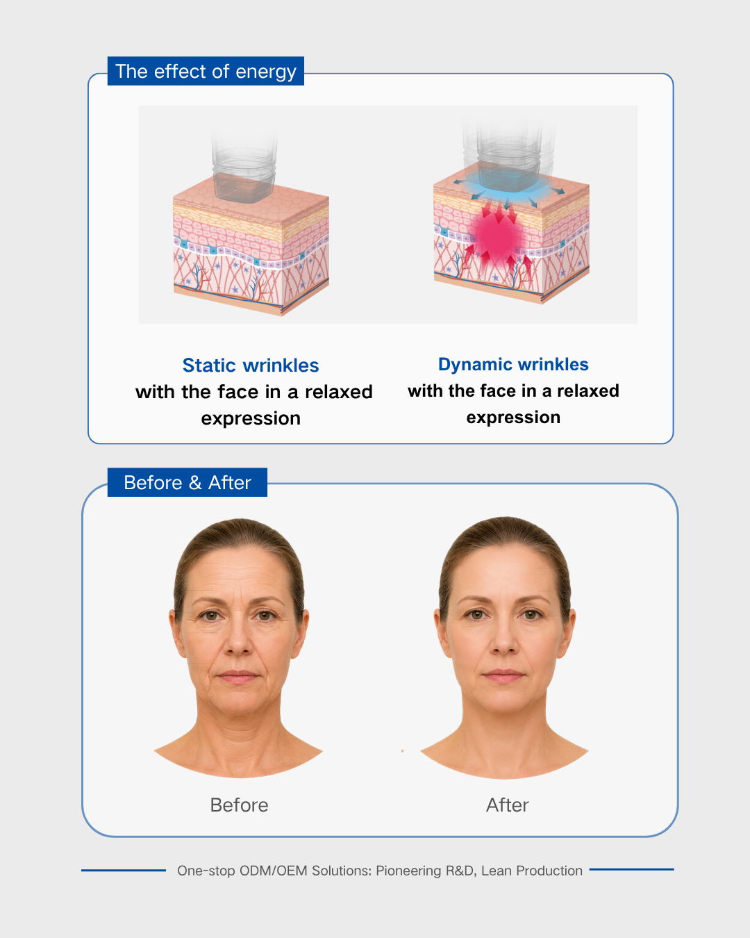 Focused Ultrasound Transducer for Body Tighte