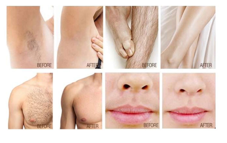 Hair Laser Removal Treatment
