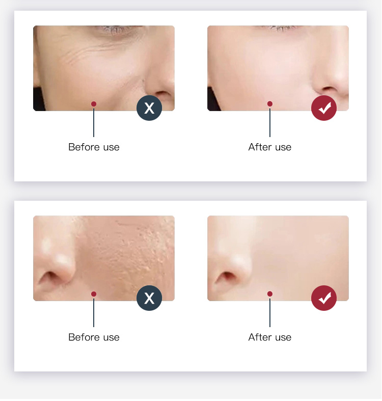 blue light treatment