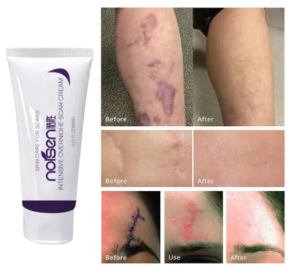 Best Wholesale Scar and Stretch Mark Removal Cream