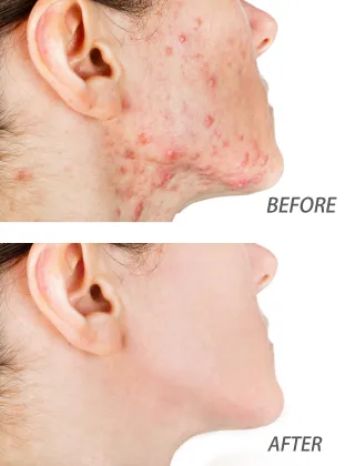 Serum Frosted Glass Bottle with Dropper for Acne and Blackhead Removal Salicylic Acid Skincare Essence