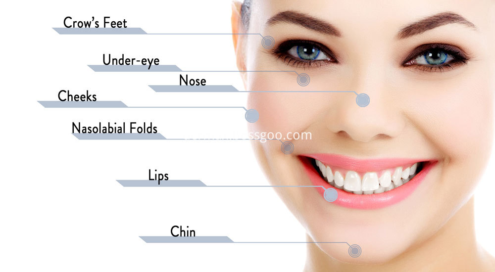 Dermal+Filler+Areas+of+Injection