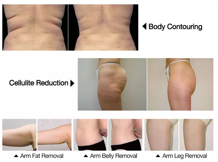 Choicy fat filezing cryo ems body contouring machine