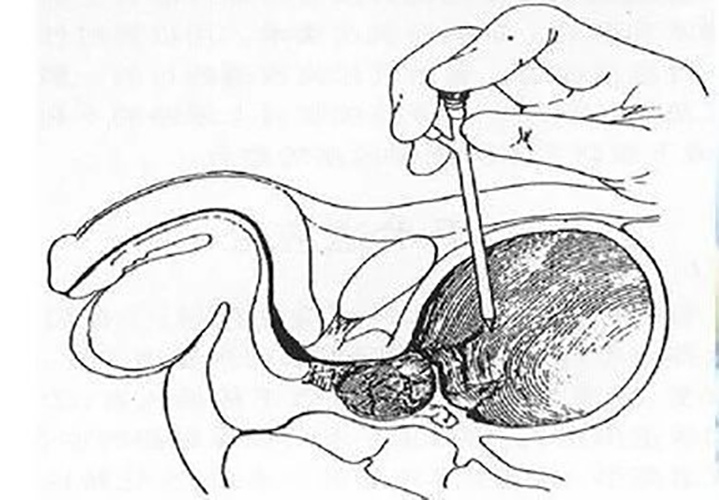 Intermittent catheter (1)