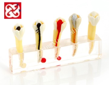 Karies Langkah -langkah Pengobatan Endodontik untuk Model Gigi Premolar