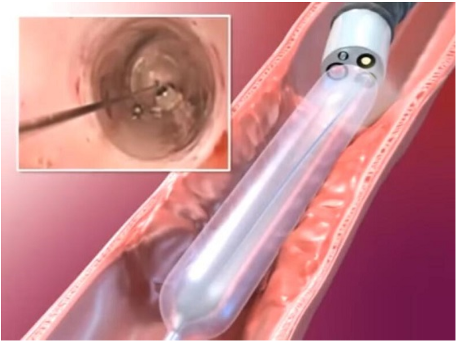 Specifications 3 Dilation Balloon Catheter-Jiangsu Changmei