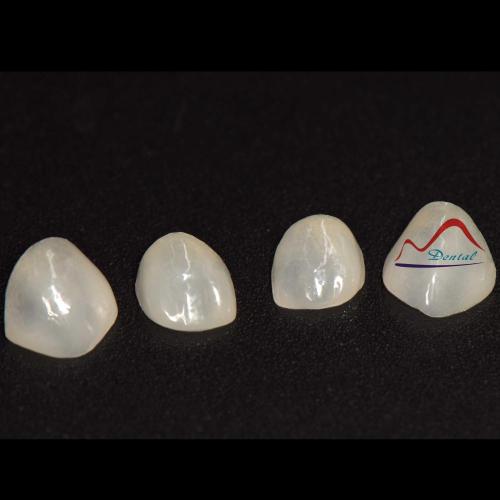 E-max Super Thin Veneer