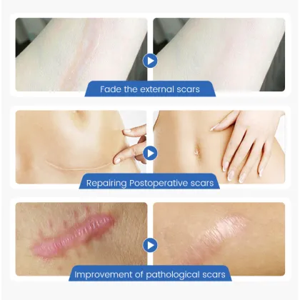 Traceless Scar Repairing Cream for Post-Surgical Scar Healing