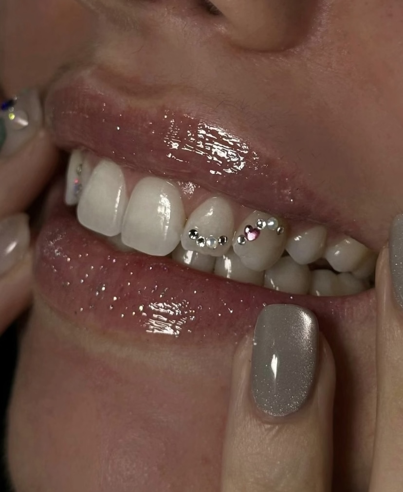 Veneers