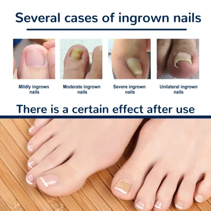 Glue-Free Ingrown Toenail Correction Sticker Patch - Foot Care Treatment