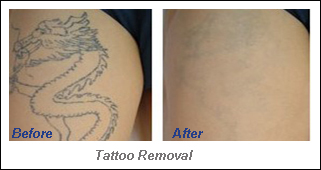 Doubling Lamp & Doubling Crystal Q Switched Yag Laser Tattoo Removal For Orthopaedics