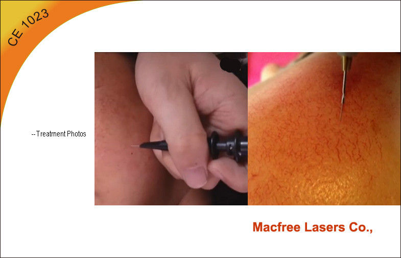 Pro 15mhz RF Laser Vein Removal Machine ，Endovenous Laser Treatment
