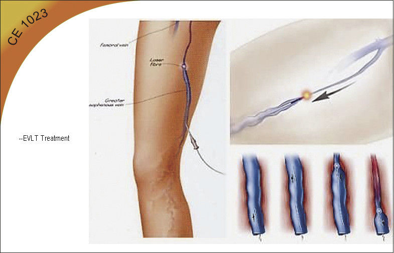 Wind Cooling Endovenous Laser Treatment , Diode Laser Lipolysis Equipment